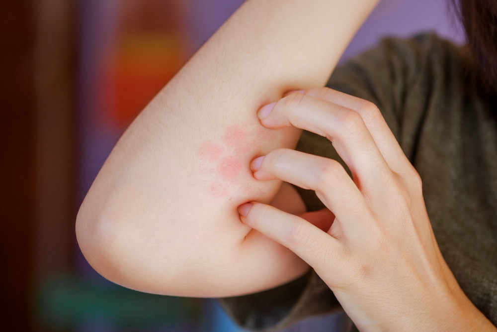 Person scratching rashes on forearm close to elbow